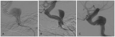 Pipeline Embolization Device for Salvage Treatment of a Willis Covered Stent Prolapse Into the Aneurysmal Sac